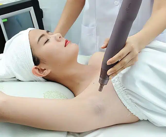 Trị thâm nách bằng Laser